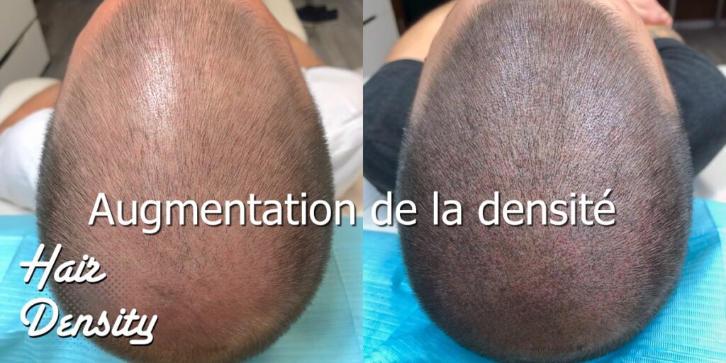 Augmentation sur alopécie diffuse avec tricopigmentation