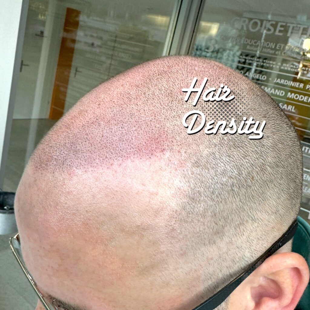 tricopigmentation hairdensity.ch