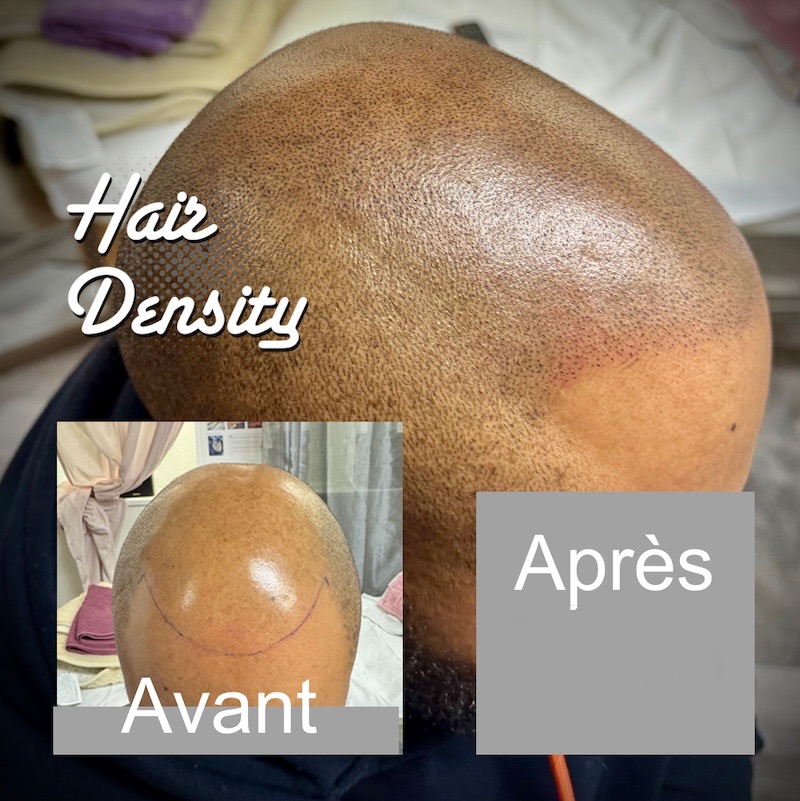 avant après trichopigmentation hairdensity.ch