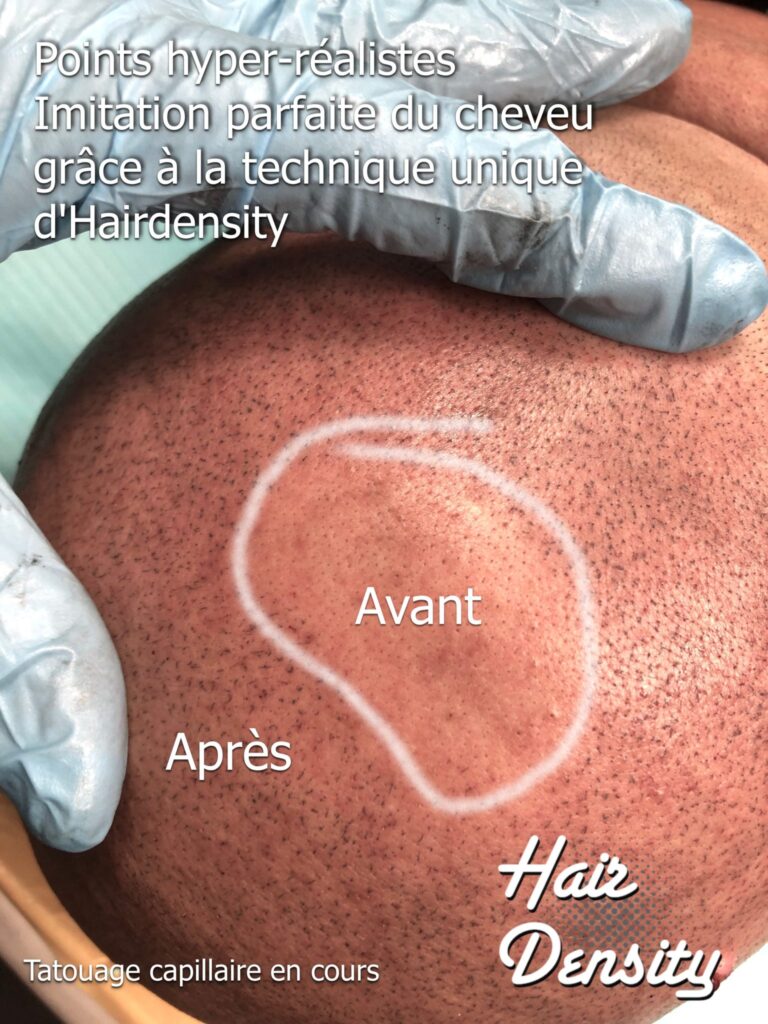 Tatouage capillaire en cours - trichopigmentation