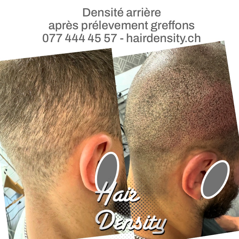 tricopigmentation tatouage cicatrice après greffe hairdensity.ch