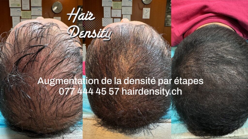 Densité 2 séances tricopigmentation