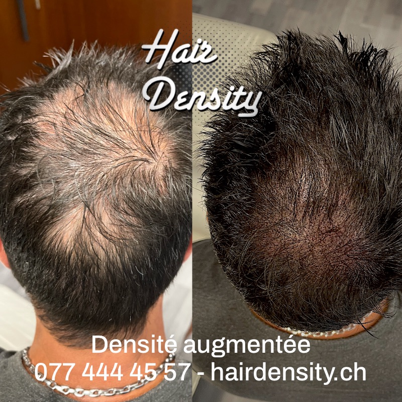 tricopigmentation densité capillaire hairdensity.ch